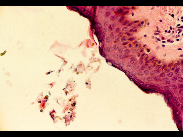 浅部真菌:花斑癣病理(图片)-临床医师